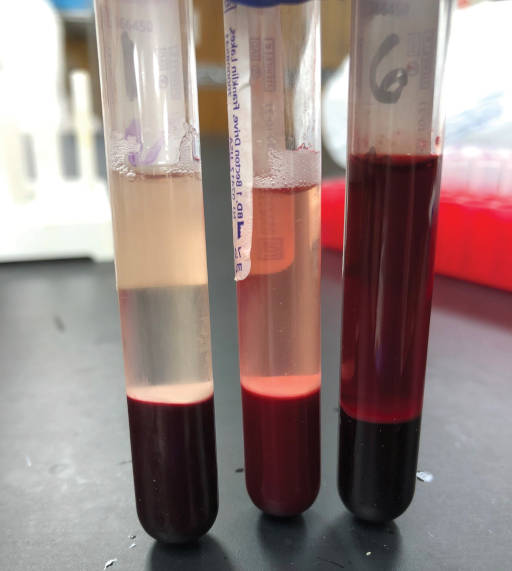 Three test tubes are oriented vertically, each containing at the bottom an opaque dark red substance with a more translucent fluid above. The leftmost (low hemolysis) fluid is slightly straw-colored; the middle is pink-tinged, and the right (high hemolysis) is much less translucent and red-colored.
